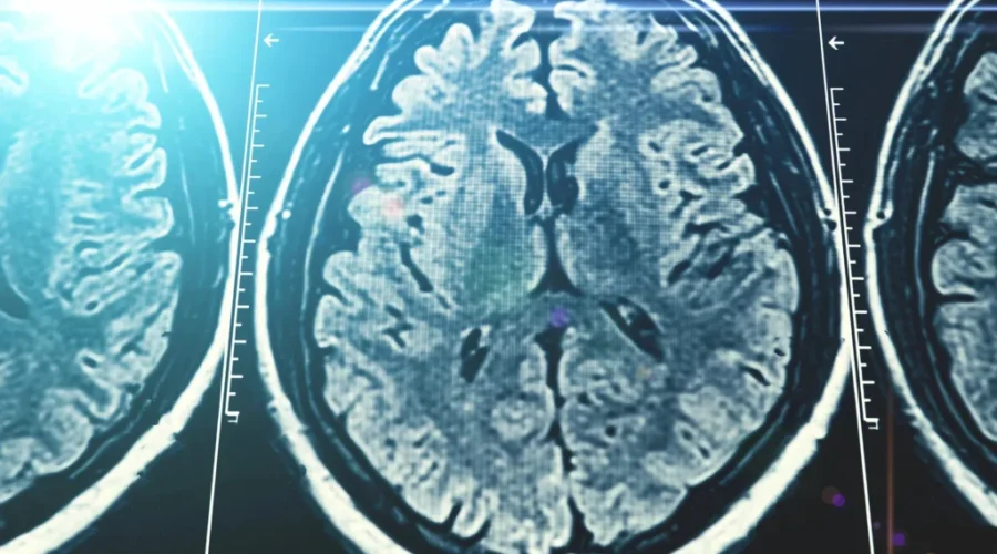 230794182 Stigma keeps many Canadians from seeking dementia help