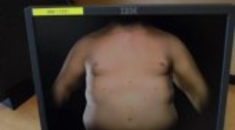 Bariatric Surgery Offered In T.Bay
