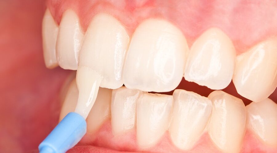 FluorideVarnish Dingwall Clinic Now Offering Free Fluoride Varnish For Kids