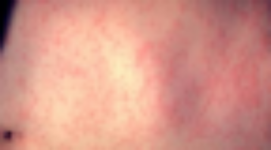 Associate Medical Health Officer Encourages Vaccination