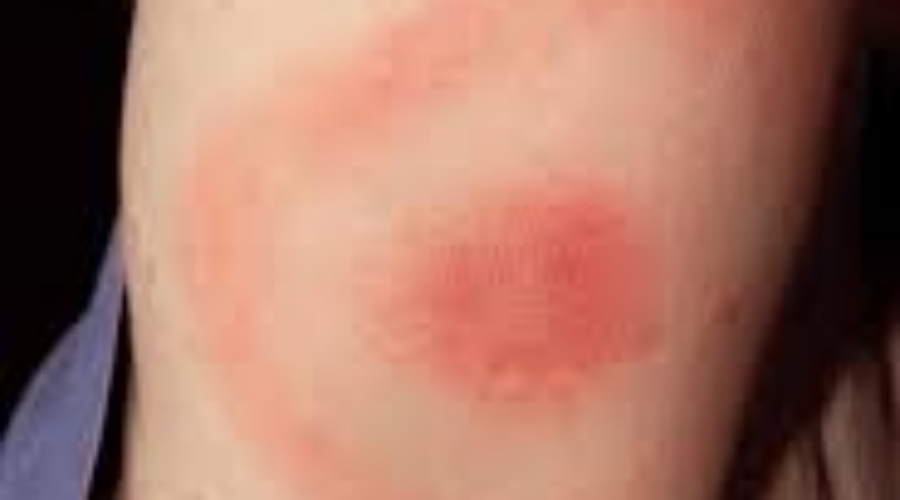 Warning Of Lyme Disease