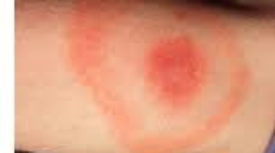 Lyme Disease Warning